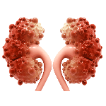 Polycystic Kidney Disease