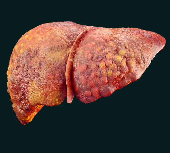 liver-cirrhosis