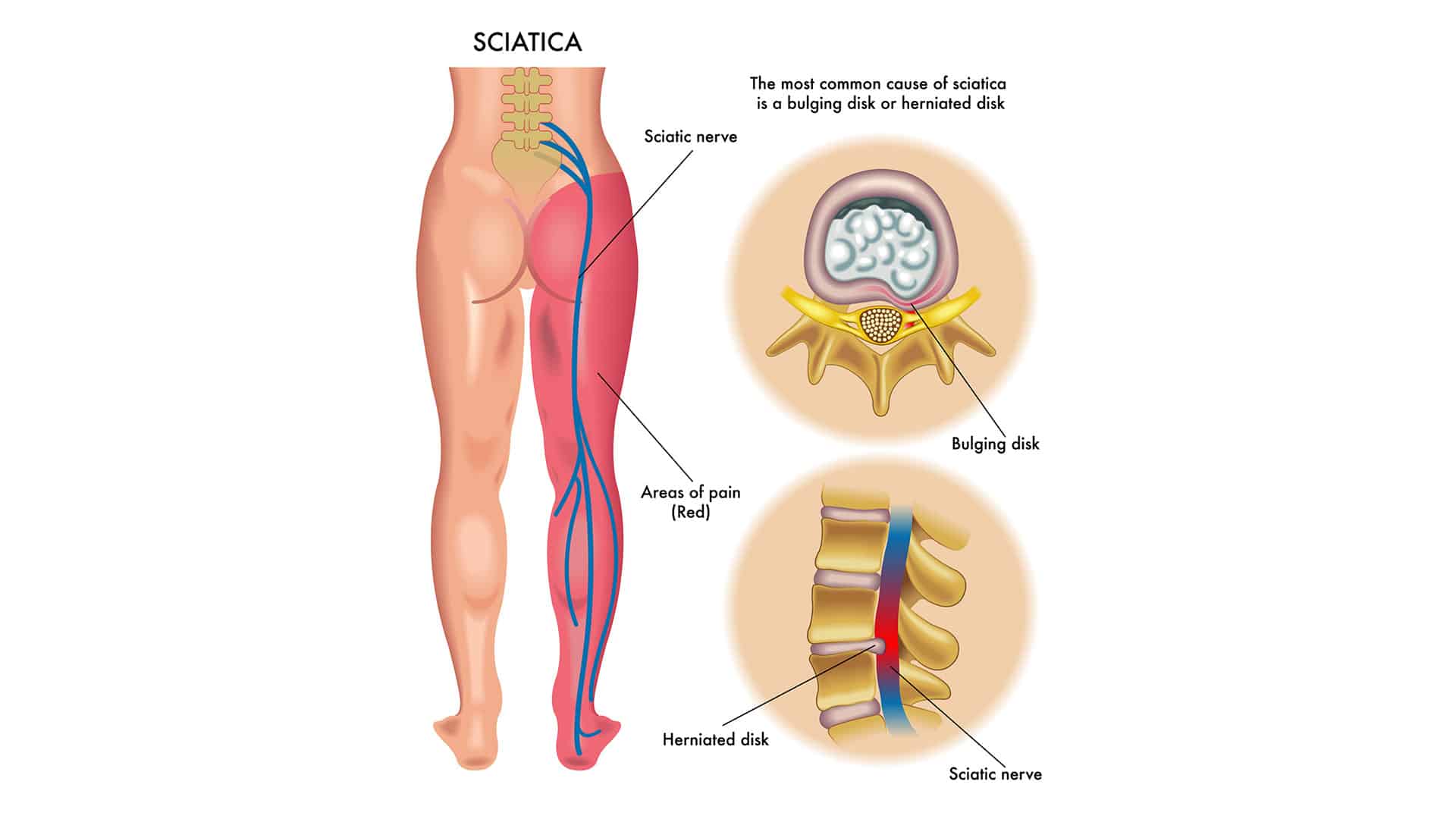 Sciatica Treatment