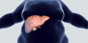 Fatty Liver