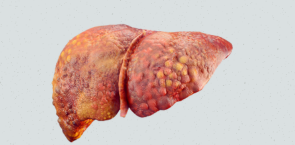 Liver Cirrhosis